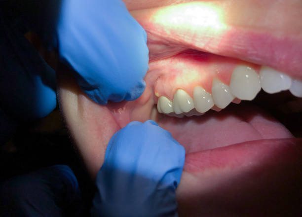 Best Emergency Broken Tooth Repair in Wolf Creek, UT